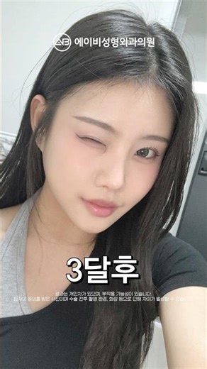 11-Month Review of Facial Contouring Surgery (Square Jaw + Chin) #shorts