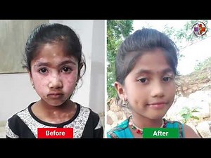 Inspiring Vitiligo Recovery Patient Story | #vitiligo | Dr Danial Clinic