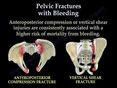 Pelvic Fractures With Bleeding - Everything You Need To Know - Dr. Nabil Ebraheim