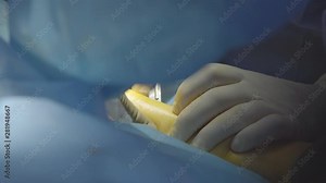 Surgeon makes an incision with a scalpel during the hand surgery (closeup, 4K, 25fps)