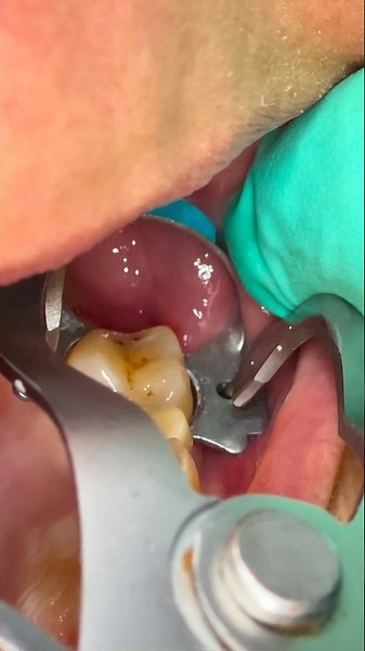 The Isolation Every Dentist Needs 🦷✨ #shorts #asmr #satisfying