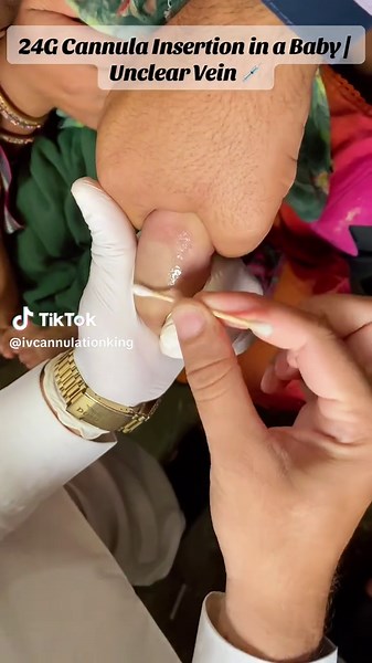 Unclear Vein in a Tiny Baby 💉 | 24G Cannula Insertion 👶 A challenging IV cannulation in a tiny baby with an unclear vein. Successfully placed a 24G cannula with careful technique and patience. 💉👶✨ #Cannulation #IVCannula #24GCannula #PediatricCannulation #BabyCannula @مُصوّرانجُم👑💫🌈