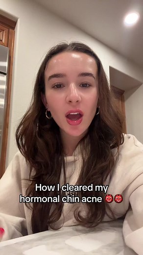 How I Cleared My Hormonal Chin Acne