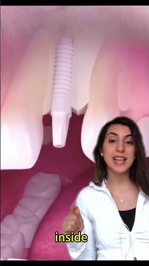 How to replacing a missing tooth!#dentist #teeth #bridge or you can try jxejxo moldable false kit#🦷