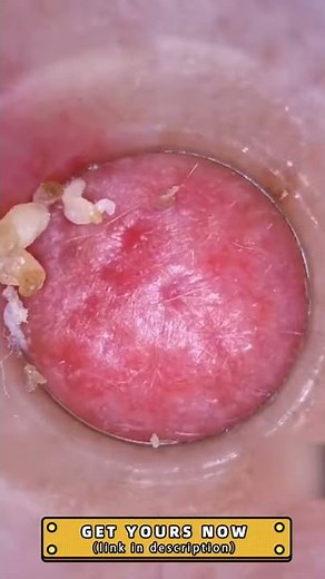 Closeup! Blackhead Remover Pore Vacuum Cleaner Review #Shorts