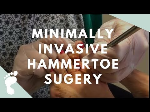 MINIMALLY INVASIVE EXTENSOR TENOTOMY & CAPSULOTOMY