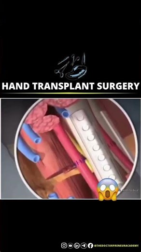 Hand transplant surgery can be life-changing ✋💉