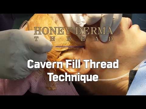 Honey Derma Thread Cavern PDO Thread Procedure | Volume Thread Instead of Filler
