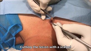 Skin lesion excision (GRAPHIC)
