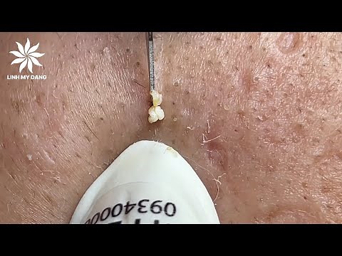 Relaxing Acne Treatment #42 | Hidden Acnes