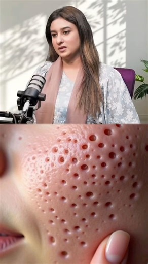 open pross remedie at home #love #trending #shorts #shortvideo #short #viral #viralvideo #skincare