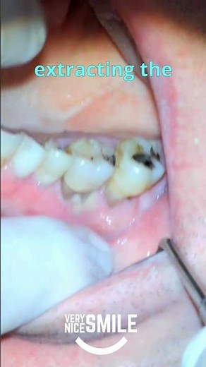 Dentist Shows Shocking Tooth Abscess!