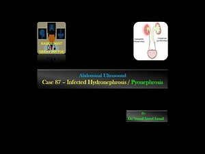 Ultrasound Case 87 -Infected Hydronephrosis / Pyonephrosis