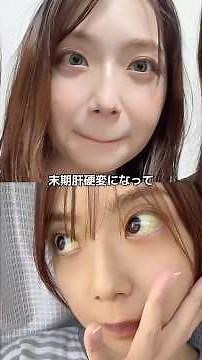 I compared my current jaundice with how I looked before. #jaundice