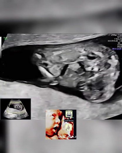 pentalogy of Cantrell fetal ultrasound by Dr.Haissam Aref, DMS, MSc, MD.Ultrasound