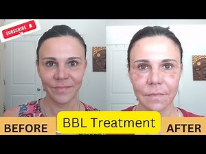Everything You Need to Know About BBL Treatment | Benefits, Procedure, and Results