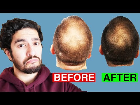 Is PRP a MIRACLE Cure for Hair Loss?