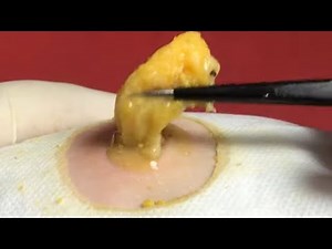 BEST Pimple Popping // Big Cystic Acne Blackheads // Whiteheads Removal / Squeezing Pimples / H#051