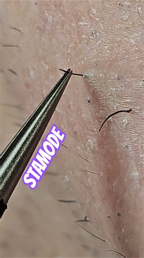 Tweezing Beard Rough Hair 😬 #tweezer #beard #roughhair #plucking