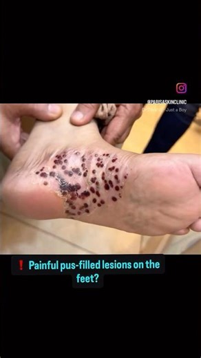 Painful Pustules on Feet? Treatable but Not Curable| What Patients Must Know ? #parisaskinclinic