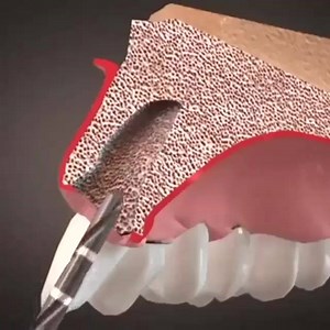 42 reactions · 69 shares | Atraumatic tooth extraction and immediate implant! New tooth!!!Great technology!! New chance to smile!!! Great change!!! New life!!  Congrats to dentistry! :) Thank you Dr. Branemark!! Exodontia atraumática e instalação imediata de implante! Um dente novo!Uma grande tecnologia!!Nova chance de sorrir!! Grande mudança!Nova vida!! Parabéns á Odontologia! :) From @quedens ( thank you) Shared by Nilda Maria Pontes,CD | Dentist's Library | Facebook