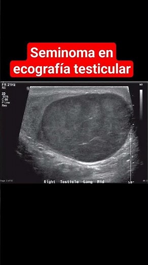 Small lump in the testicle on ultrasound
