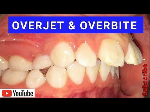 Overjet & Overbite | Causes & Treatment Using Braces & Invisalign