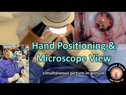 Hand Positioning and simultaneous Microscope View in Cataract Surgery