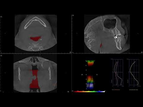 Upper Airway Analysis in CBCT. Obstructive Sleep Apnea (OSA) ??