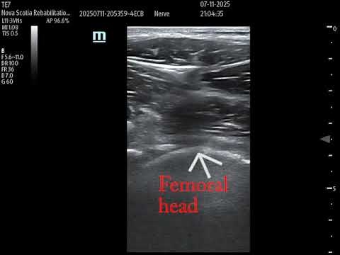 Intra-articular hip injection: ultrasound technique