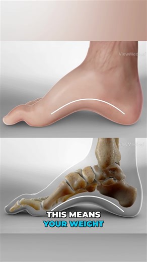 Viz Medical on Instagram: "Pes cavus, also known as a high-arched foot, is a condition characterized by an abnormally high arch, leading to increased pressure on the ball and heel of the foot and potentially causing pain. #medicaleducation #medicalanimation #3danimation #3dmedicaleducation #3danimationsurgery"