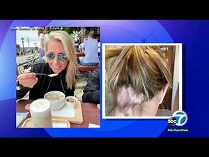 Olaplex hair products left customers with bald spots, blisters, lawsuit alleges