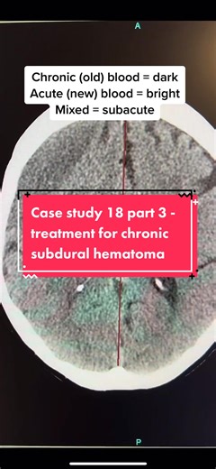Reply to @ladyspinedoc treatment for chronic subdural hematoma #brainsurgery #craniotomy #burrholes #subdural #learnontiktok #neurosurgery #takeaNAIRbreak