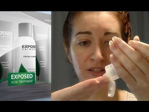 How To Use Exposed Skin Care (REQUESTED!) My At Home Acne Treatment System!