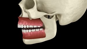 Overbite dental occlusion ( Malocclusion of teeth ). Medically accurate tooth 3D animation