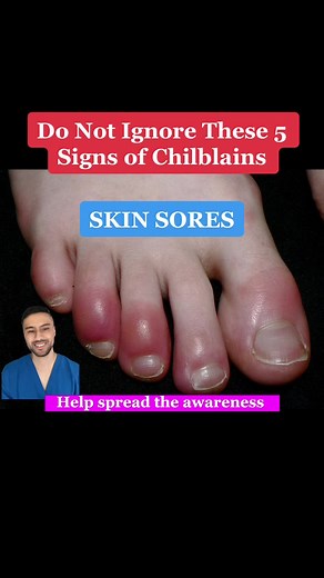 5 Signs of Chilblains on Your Feet - Recognize the Symptoms!