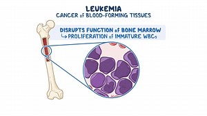 Video: Leukemia - Video Explanation! | Osmosis | Osmosis