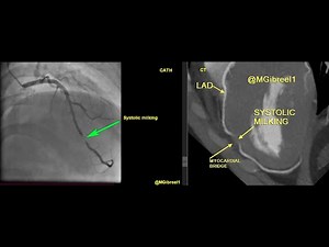 Systolic milking of a deep myocardial bridge of the late mid-LAD CT & Cath