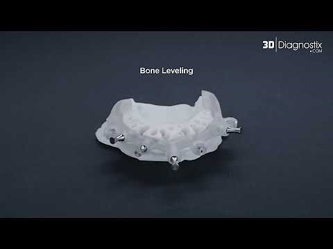 MagnetiX™ Stackable Guides & PMMA | Hands-On Digital Surgery Tutorial