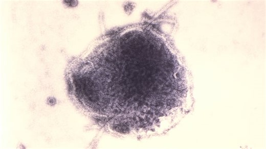 Alberta Medical Association increases calls for measles vaccinations