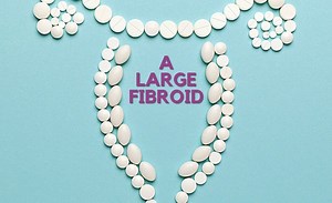 What Is Considered a Large Fibroid? Fibroid Size Chart