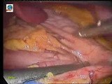 Laparoscopic Sleeve Gastrectomy in 10 steps - Part 1 • Video • MEDtube.net