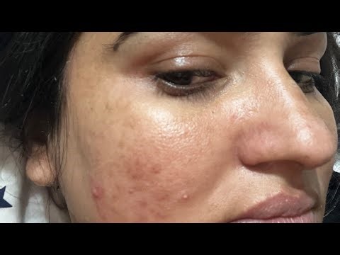 Hydroquinone Routine That Actually Works | Step-by-Step for Hyperpigmentation