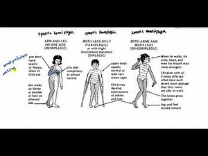 Cerebral Palsy for USMLE Step 2