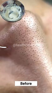 Rmove Blackheads & Whiteheads From Nose Easily At Home 💯✅ . . . #removeblackheads #whiteheads #blackheads #skincareroutine #reelsviralシ #fbreelsfypシ゚ #fypreels #reelsfacebook #explorepage | Health Care Zone