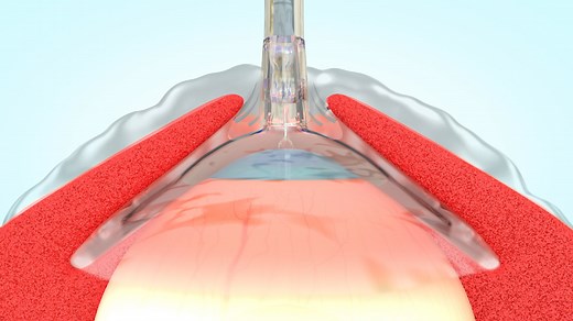 The Morgan Lens | "Hands-free" eye irrigation method
