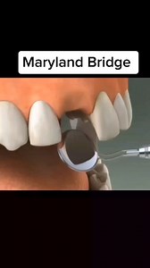 11K views · 48 reactions | Maryland Bridge on one missing Tooth #fbreelsfypシ゚viralfbreelsfypシ゚viral #irumadental #docanneirumalinto #fbreelsfypシ゚ #justsharingmyexperience #oralhealth #oralcaretips #tooth #missingtooth #marylandbridge #dentalcare #dental #dentalclinic | Iruma Dental Clinic | Facebook