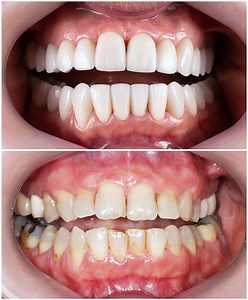 Emax ceramic crowns and veneers