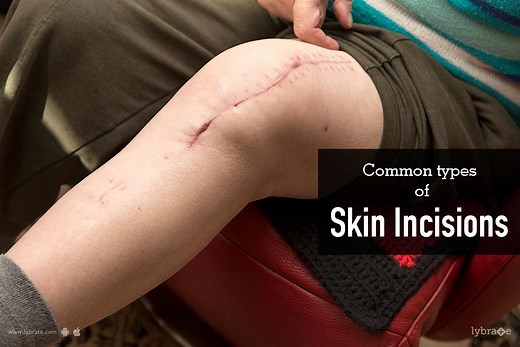 Common Types Of Skin Incisions - By Dr. Rohit Batra | Lybrate