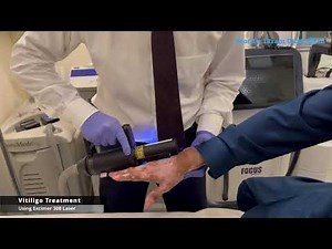 Excimer 308 laser treatment for Vitiligo Patches by Prof.Dr.Ikram Ullah Khan